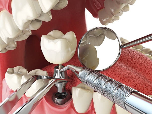 Best Emergency Wisdom Tooth Extraction in Thornwood, NY